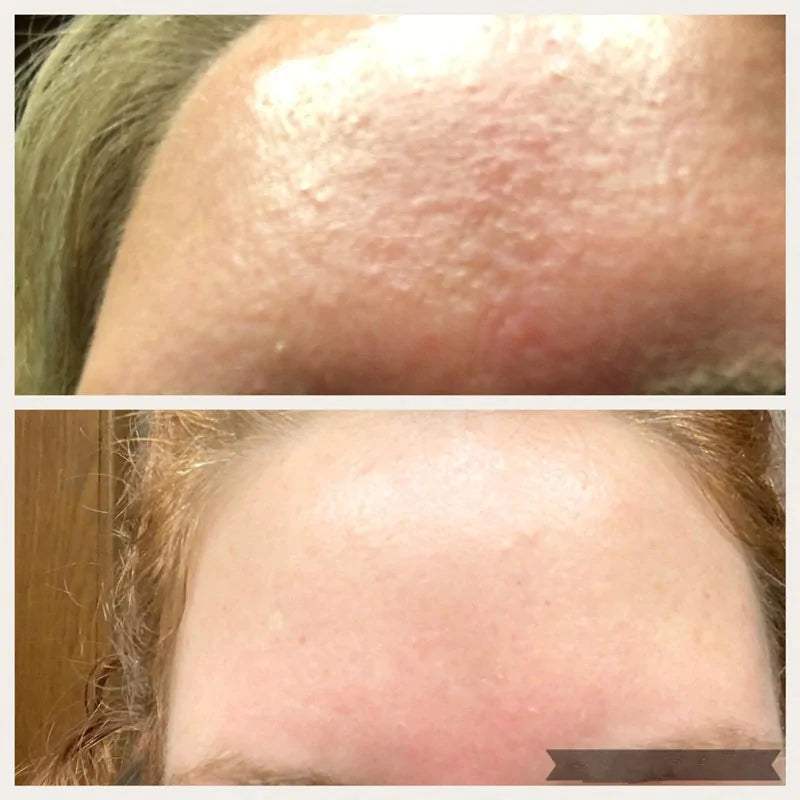 The Ordinary - 30ml AHA 30% + BHA 2% Face Peeling Solution Serum