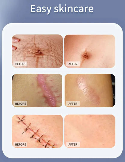 Hons Medical Silicone Scar Sheets